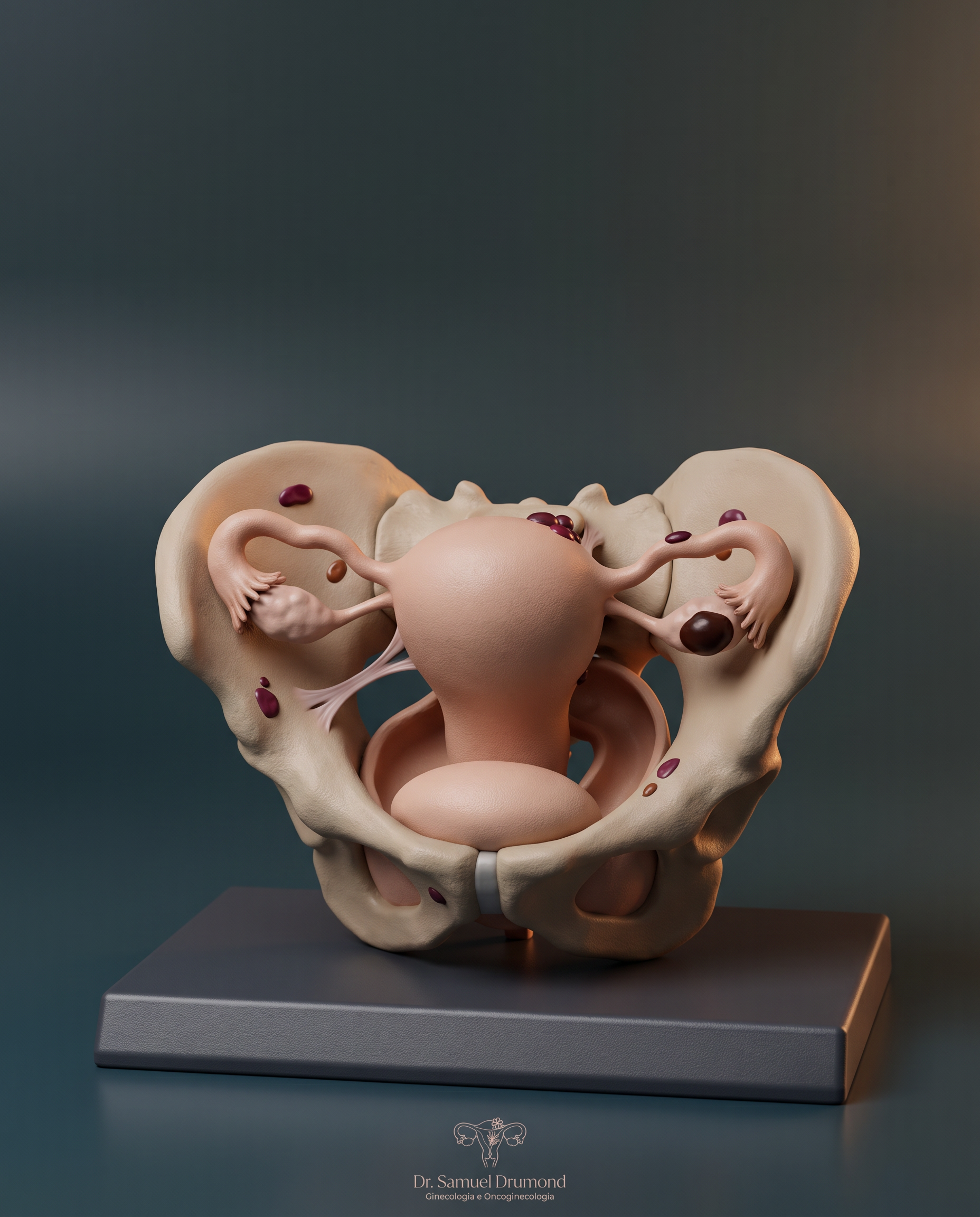 Ilustração representativa de endometriose